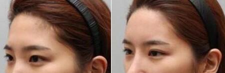 因为额头足够饱满 拍照比以前格外的好看