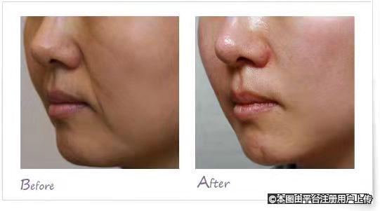 嘴角皱纹消失了 人也显年轻不少